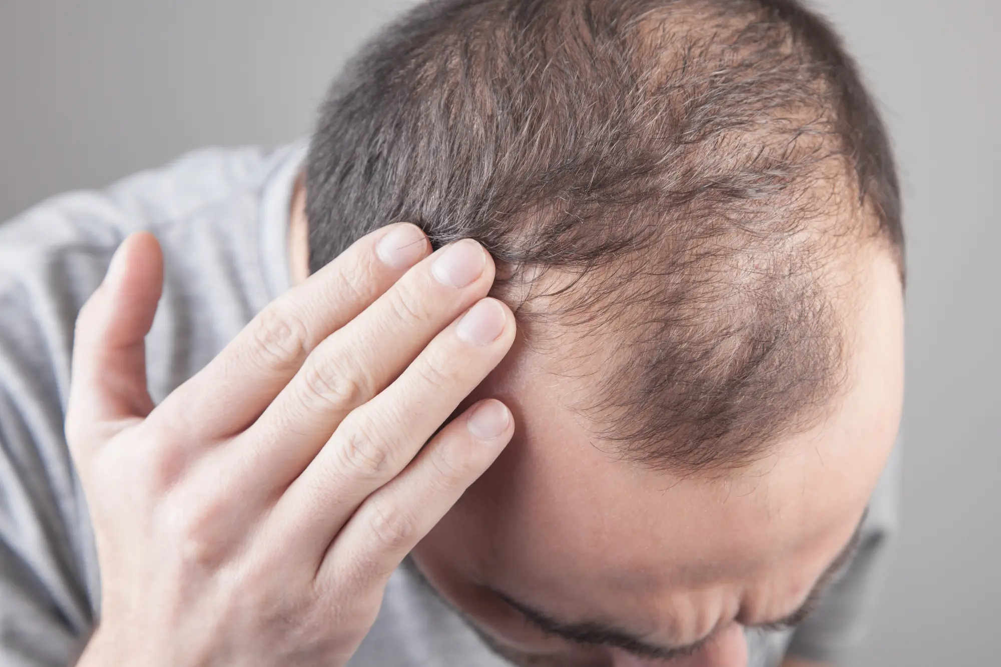 a client at Biltmore Dermatology ready for hair loss treatment